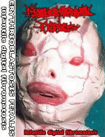 Erythrioblastosis Fetalis : Infantile Digital Fibromatosis